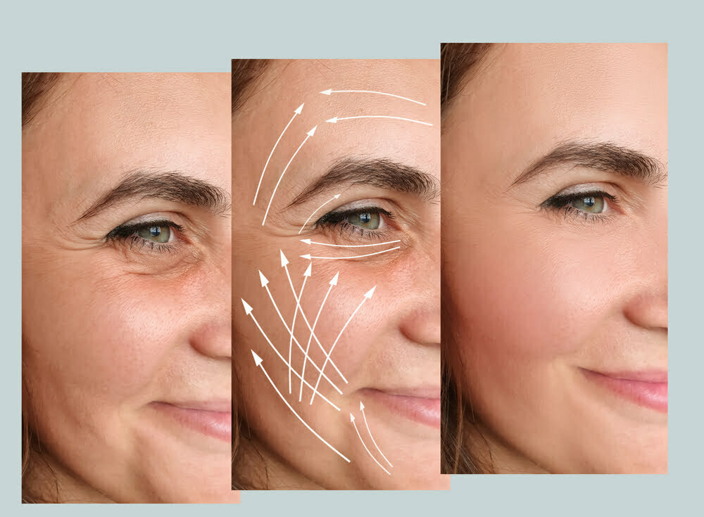 Woman,Face,Wrinkles,Before,And,After,Treatment